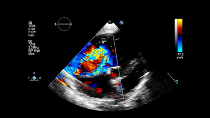 Image of the heart during transesophageal ultrasound with Doppler mode.