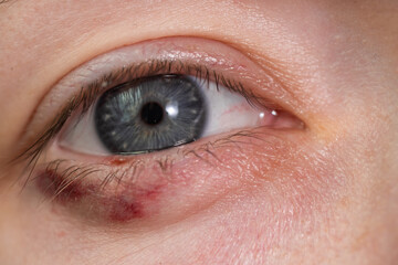 Close-up of a child's eye stye. Ophthalmic hordeolum disease