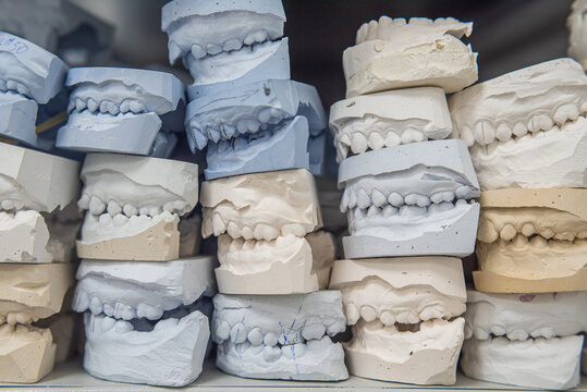 Warehouse of plaster models of human jaws in an orthodontic clinic. Control and diagnostic dental casts for aligners.