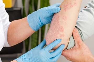 A dermatologist wearing gloves examines the skin of a sick patient. Examination and diagnosis of...