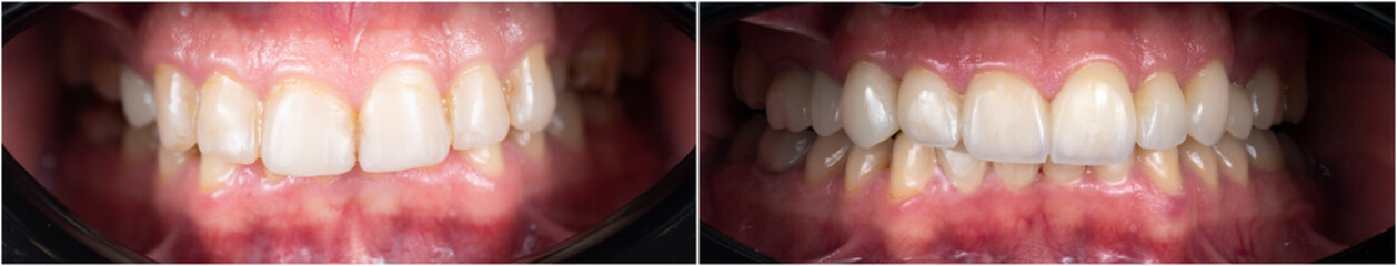 press ceramic crowns and veneers A2 color