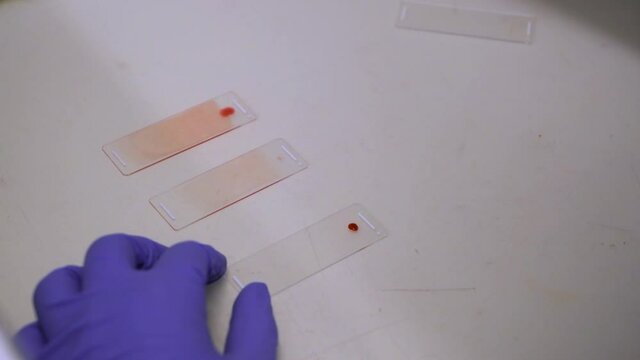 Placing Drop Of Blood Sample On One End Of Glass Microscope Slide - Blood Film (Peripheral Blood Smear - high angle shot