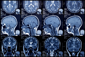 Fragment of an MRI scan of the brain. Diagnosis of the disease, prescription of treatment.