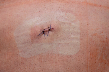sutures on the wound after laparoscopic surgery