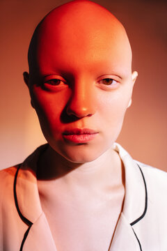 Woman with alopecia in red neon light