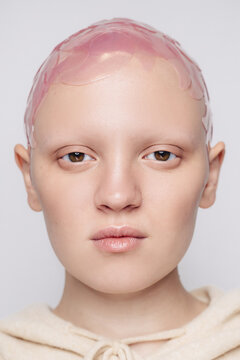 Young hairless woman with patches on head