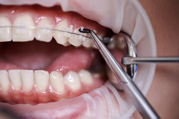 Close up view on dentist taking off black rubber bands from ceramic braces with a help of dental...