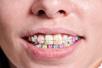 Horizontal close-up snapshot of beautiful woman's smile, demonstrating white healthy teeth with ceramic braces, united with a wire and colorful rubber bands. Front view with a tip of nose