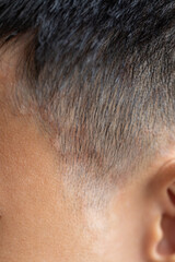 Obraz premium Tinea circinata or ringworm on the head. 