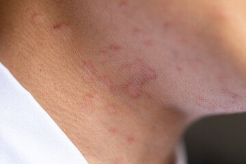 Fototapeta premium Tinea circinata or ringworm on the head. 