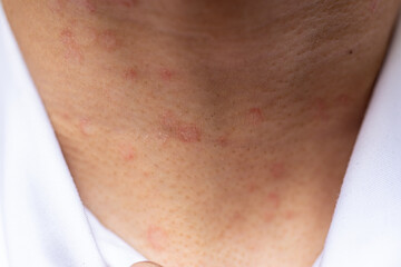 Tinea circinata or ringworm on the head.
