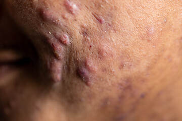 Fototapeta premium Backgrounds of lesions skin caused by acne on the face in the clinic. 
