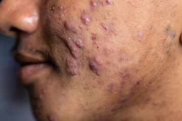 Naklejka premium Backgrounds of lesions skin caused by acne on the face in the clinic. 