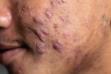 Backgrounds of lesions skin caused by acne on the face in the clinic.
