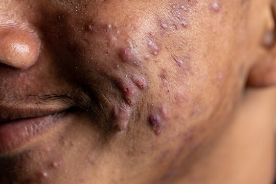 Backgrounds of lesions skin caused by acne on the face in the clinic.
