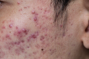 Fototapeta premium Backgrounds of lesions skin caused by acne on the face in the clinic. 