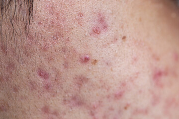 Backgrounds of lesions skin caused by acne on the face in the clinic.
