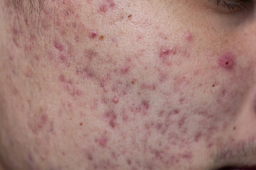 Fototapeta premium Backgrounds of lesions skin caused by acne on the face in the clinic. 