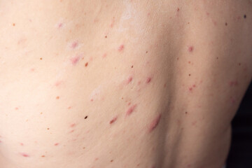 closeup a man back who having varicella blister or chickenpox