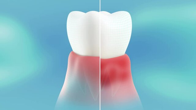 Periodontitis on the gums. Conceptual showing the dental cure of this disease. A healthy tooth is cut in half with the sick one. The video is in a loop.