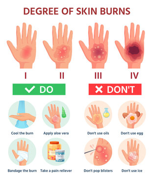 Burns degree. First aid for burn wound. Fire damage to skin classification. Hand blisters. Vector infographic treatment for thermal wound. Illustration injury pain damage, medicine help