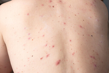 closeup a man back who having varicella blister or chickenpox
