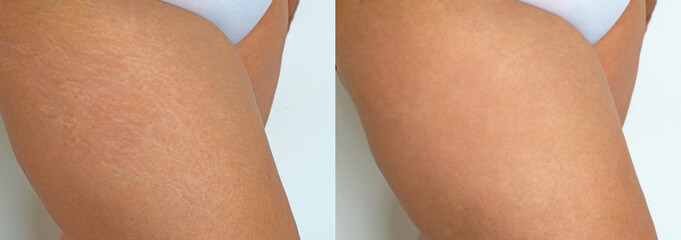 Stretch marks on woman legs, before and after treatment