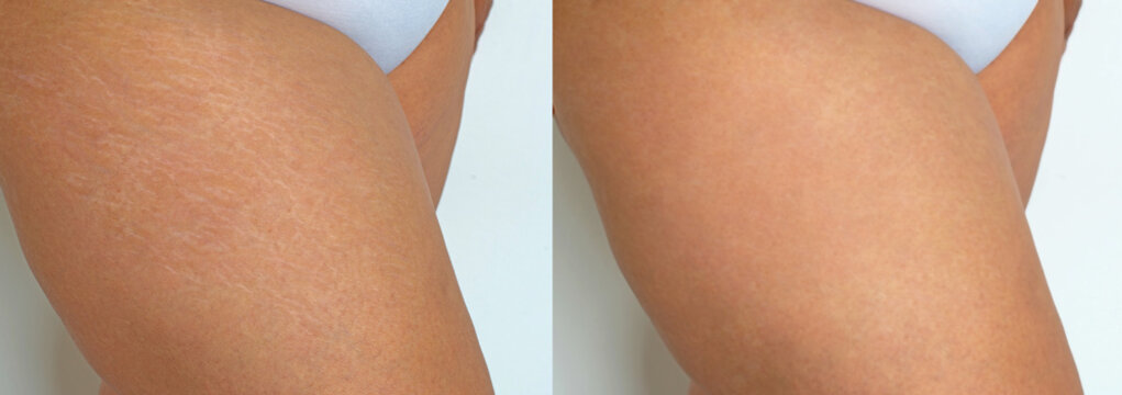 Stretch marks on woman legs, before and after treatment