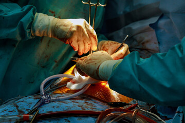 Team of surgeons in hospital open heart surgery in operating room