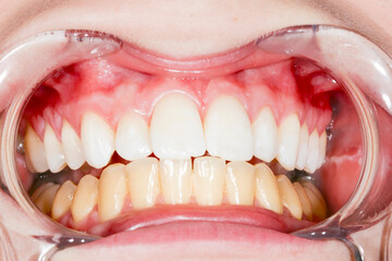 Before and after teeth bleaching or whitening treatment. Close-up of young Caucasian female's smile.