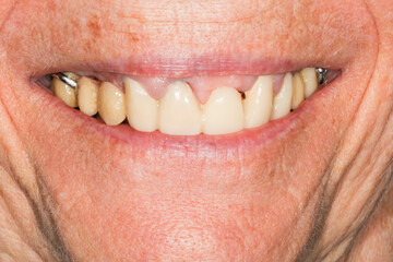 Peri-implantitis : Diseases that cause loss of bone around the dental implant