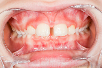 Fototapeta premium Open child mouth with gap between tooth macro. Dental doctor check state of teeth