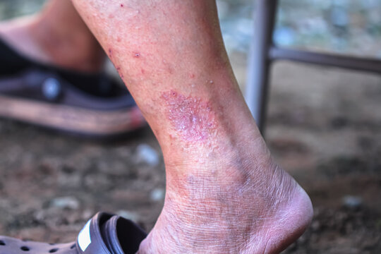 Close Up Asian Woman Has Flaky And Red Rash Infection On Her Ankle