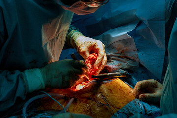 During surgery doctor close up hands of open heart of surgeons