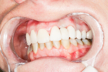 woman teeth before and after whitening. Imperfect dentition. Up done, down to do, by the dentist,...