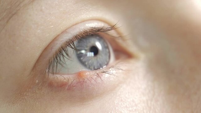 Young woman with hordeolum disease in the eye.