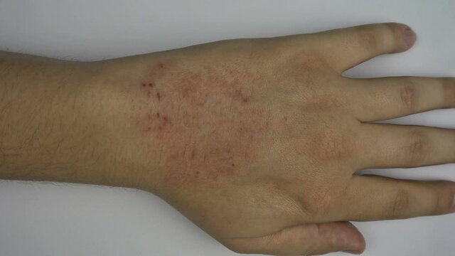 Painful marks on the skin hand, like an irritation, allergies, bites, dry skin problem, burns.