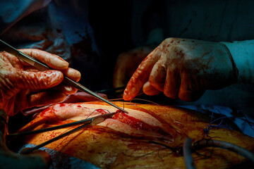 Surgeons suturing on sick patient after an operation performing a serious surgery.