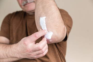 psoriasis ointment. treatment of skin diseases using ointments as dosage form of drug. Patient causes medical therapeutic ointment thick consistency or cream moisturizer on skin in elbow area close-up