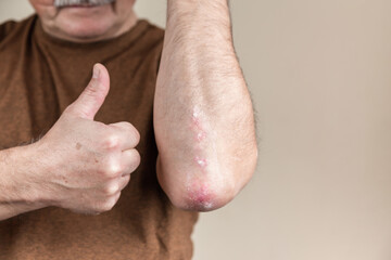 Successful psoriasis treatment. Successful psoriasis treatment. A man shows his thumb up next to the elbow for psoriasis. It turned out to cure a skin disease