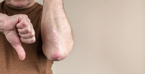 Failed psoriasis treatment. A man shows his thumb up next to the elbow for psoriasis. it was not...