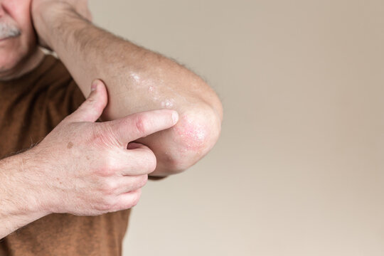 Psoriasis on the elbow. Closeup dermatitis on skin ill allergic rash dermatitis eczema of patient atopic dermatitis symptom skin detail texture, Fungus concept dermatology, treatment fungal and fungal