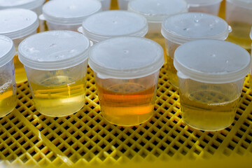 Series of test tubes with coloring Urine.