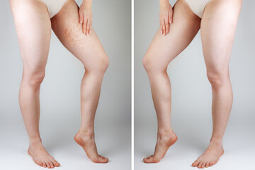 The concept of varicose veins and cosmetic treatment. The woman points to the vascular asterisks on...