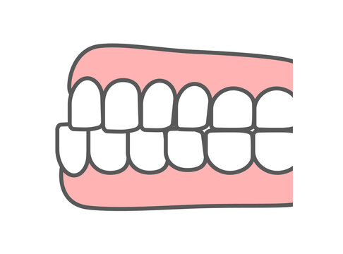 歯科_歯並び_下顎前突・受け口