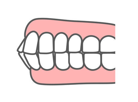 歯科_歯並び_上下顎前突