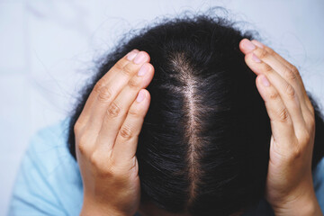 close up woman hair loss to head bald and frizzy. caused by problem health care shampoo and beauty product concept.
