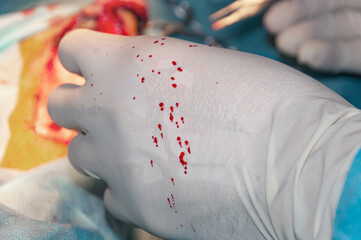 Hand of a surgeon during surgery. Drops of blood on the glove (concept profession)