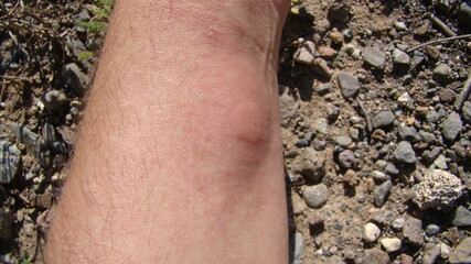 bee : stung by a bee worker.
skin allergy , allergic
treatment by honey bee sting
closeup honey bee stinging a hand
insects, insect, animal, wildlife, wild nature, forest, garden
beauty of pollination