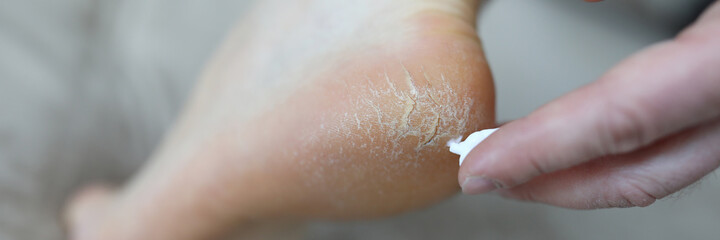 Close-up of person applying smoothing cream on damaged and problem areas on skin. Barefoot man with unhealthy and unattractive heel. Effect of uncomfortable shoes